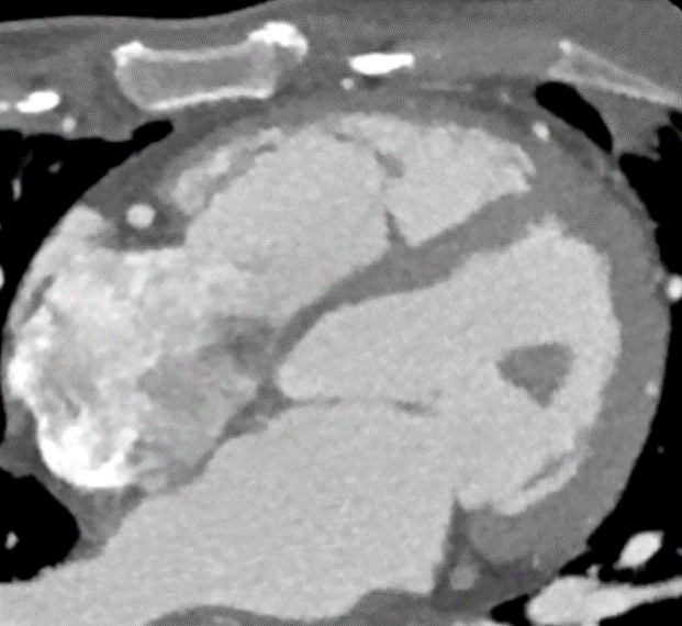 37/F, incidental lesion