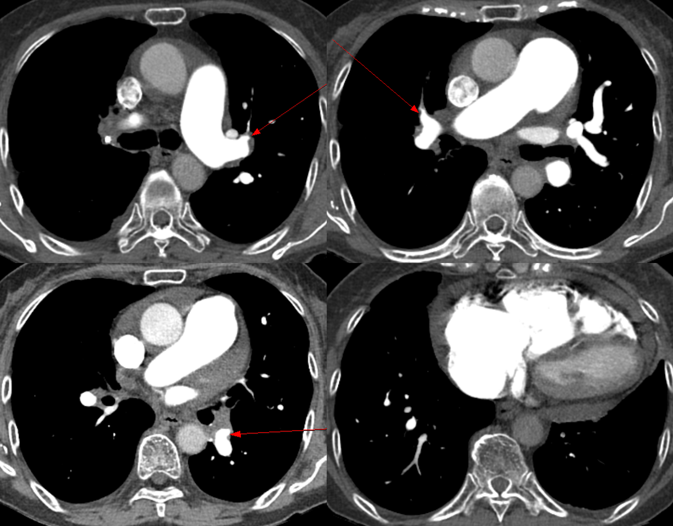 66/F, dyspnea on exertion
