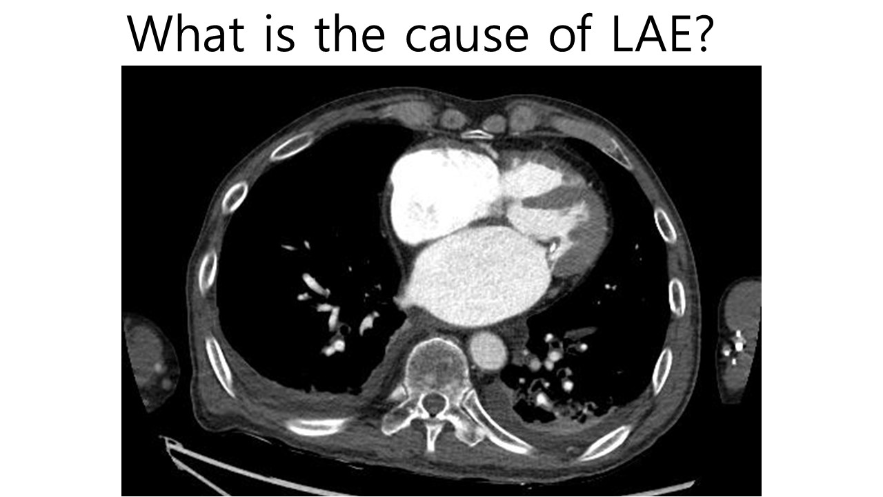 71/M, What causes LAE?