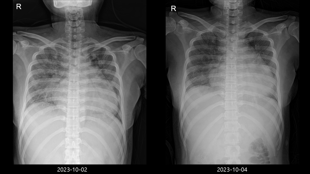 20/F, dyspnea, vomiting (onset : 1 weak ago)