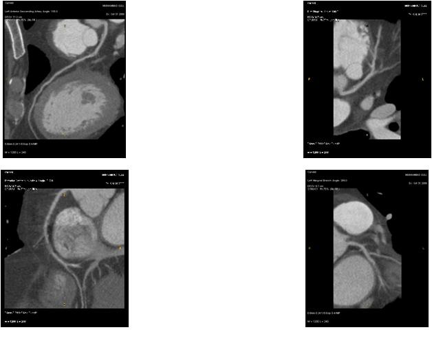 M/50, C.C.: Chest Pain on effort; CAD risk factors: Hypertension, smoker / HR at MDCT scan: 68 bpm