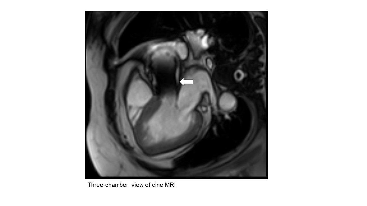70/F, Further evaluation of heart function, Cardiac MRI shows abnormal findings in the aortic root