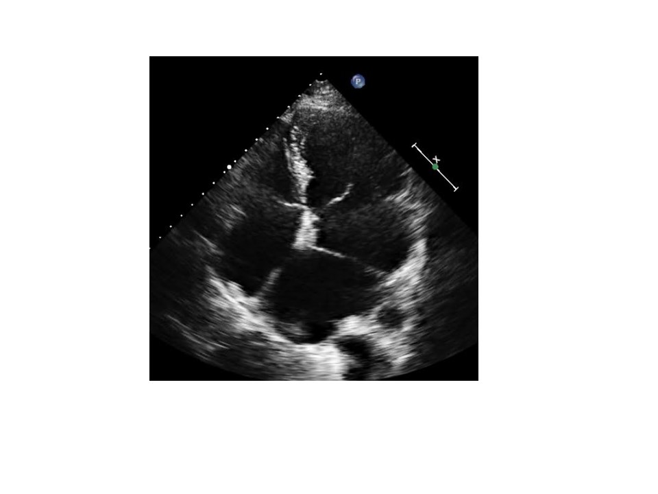 39/F, dyspnea on exertion