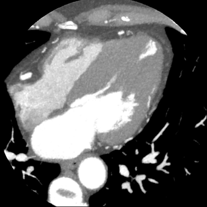 57/F, Chest pain