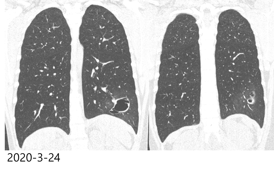 19/M, Hemoptysis, recurrent pneumothorax, joint hypermobility