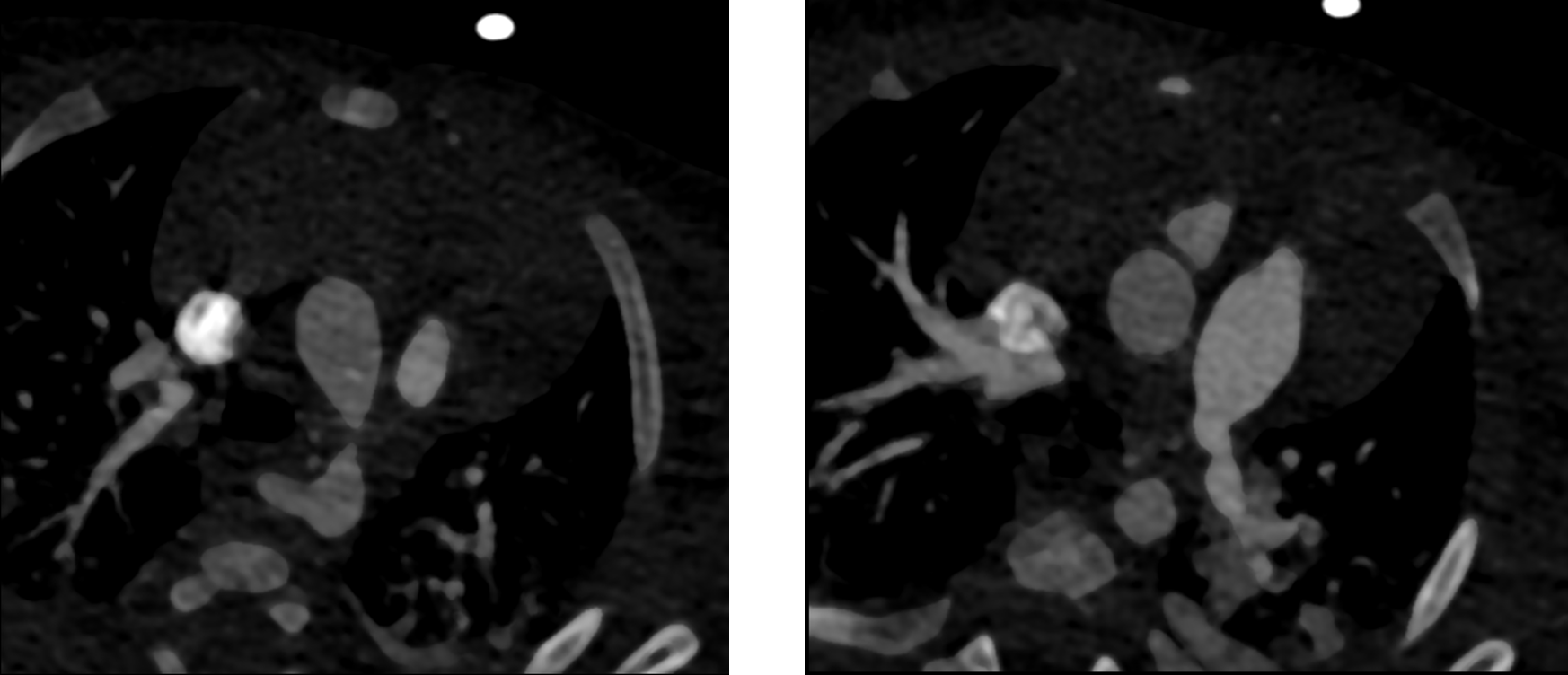 Partial anomalous pulmonary venous return (PAPVR) and atrial septal defect (ASD)