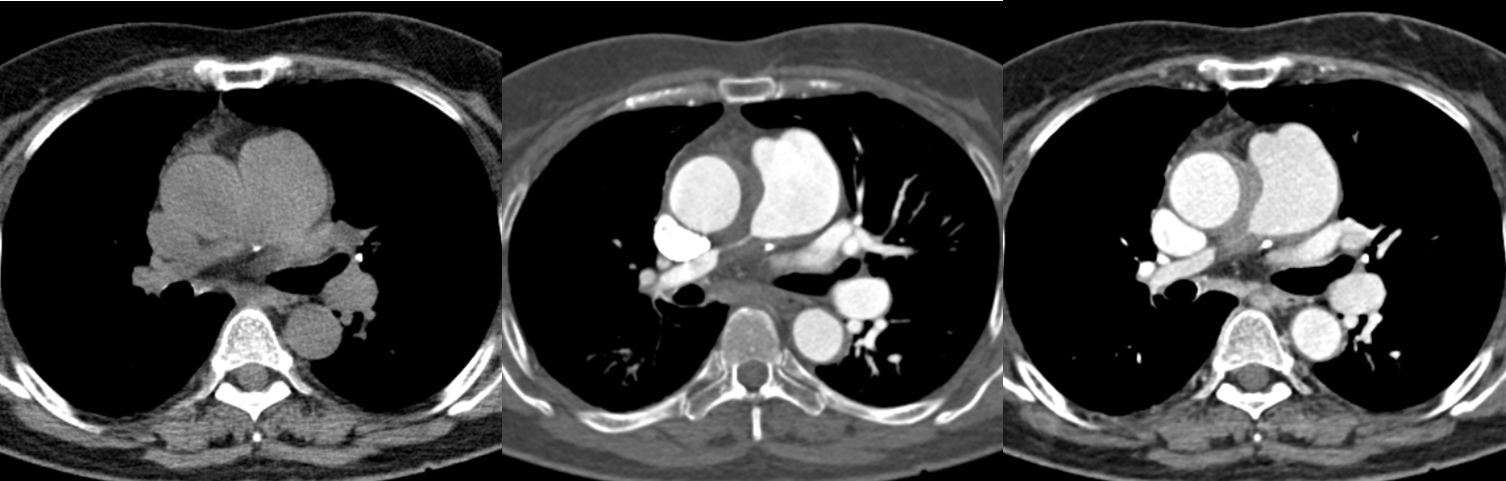 65/F, dyspnea on exertion
