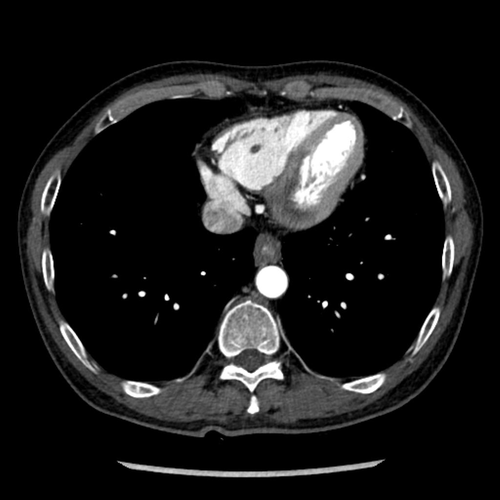 60/M, regular follow-up CT with hepatocellular carcinoma
