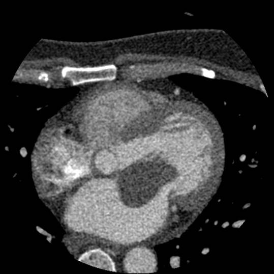 LA myxoma