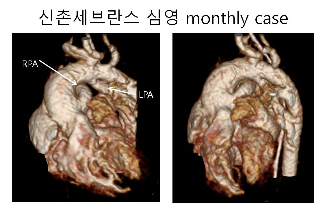 0/F, abnormal finding on echocardiography