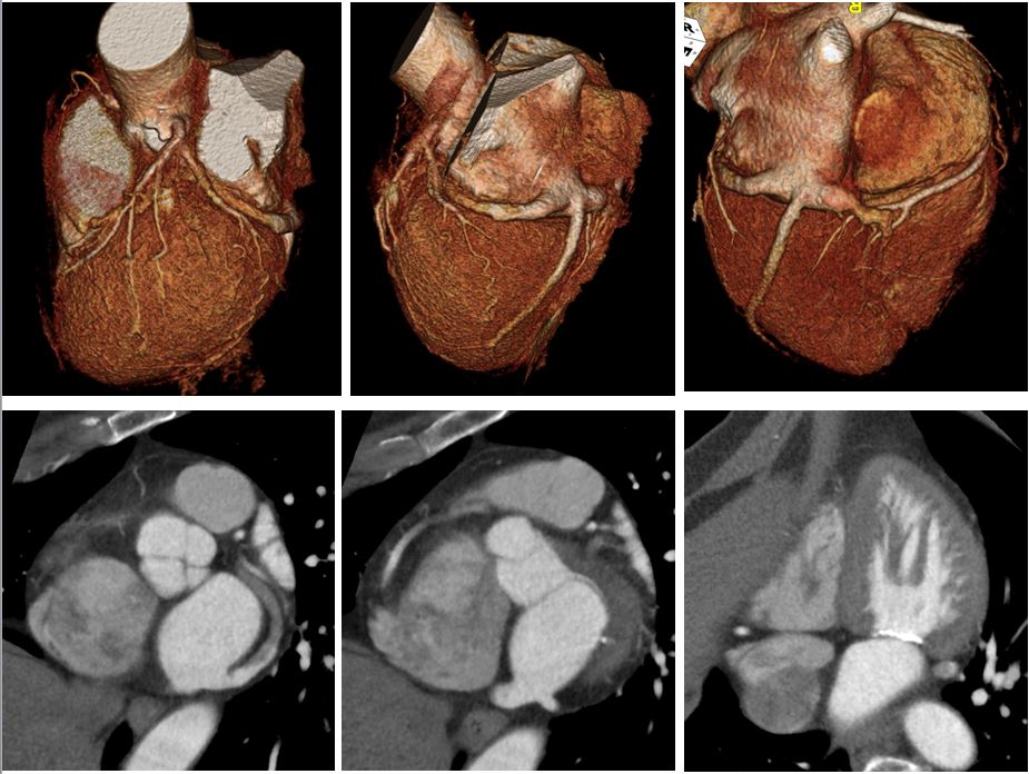 58/F, chest pain