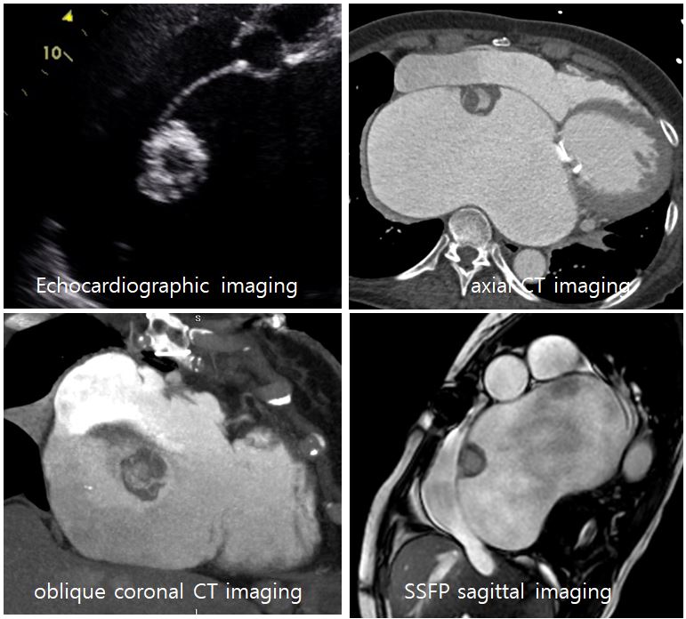 69/F, dizziness, s/p mitral valve replacement due to mixed mitral stenosis and regurgitation, s/p tricuspid