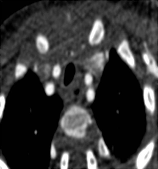 1/M, recurrent respiratory infection