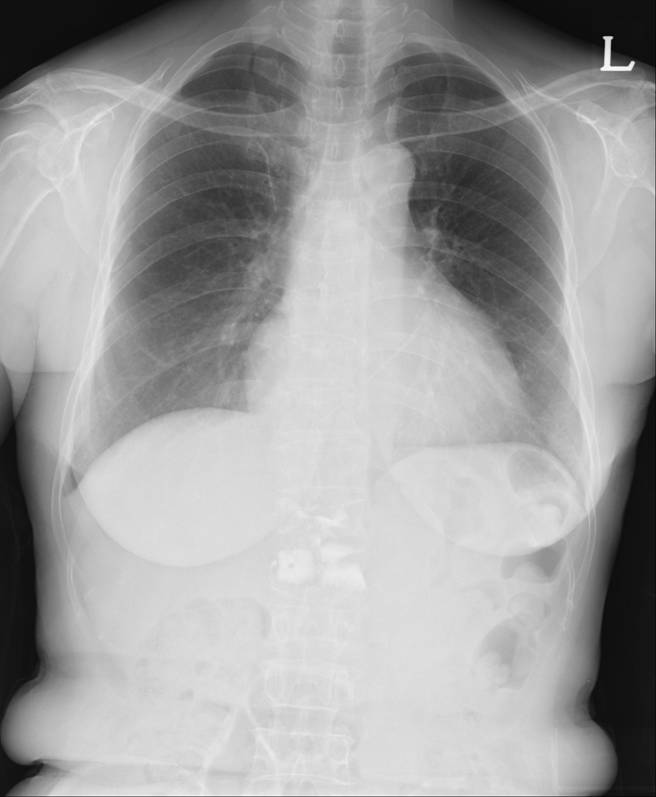 59/F, chest pain(5 days ago)