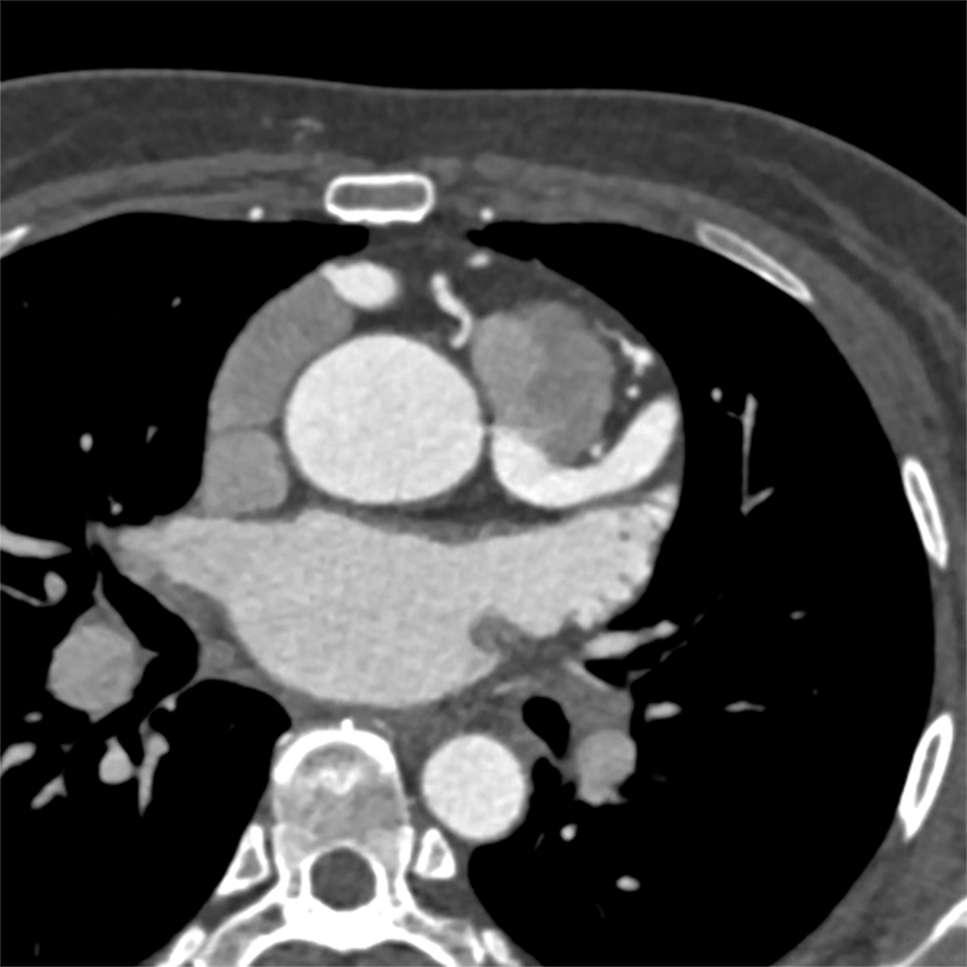 46/F, dyspnea