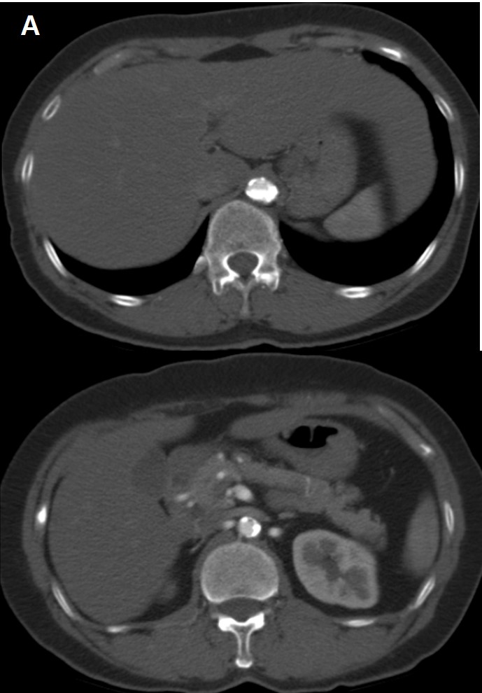 62/F, long standing uncontrolled hypertension