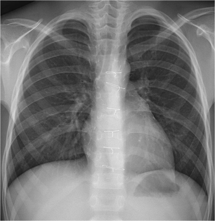16/M, cardiac CT for routine F/U