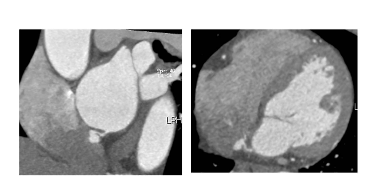 Heart   59 / F,  Incidental abnormality detected on Cardiac CT