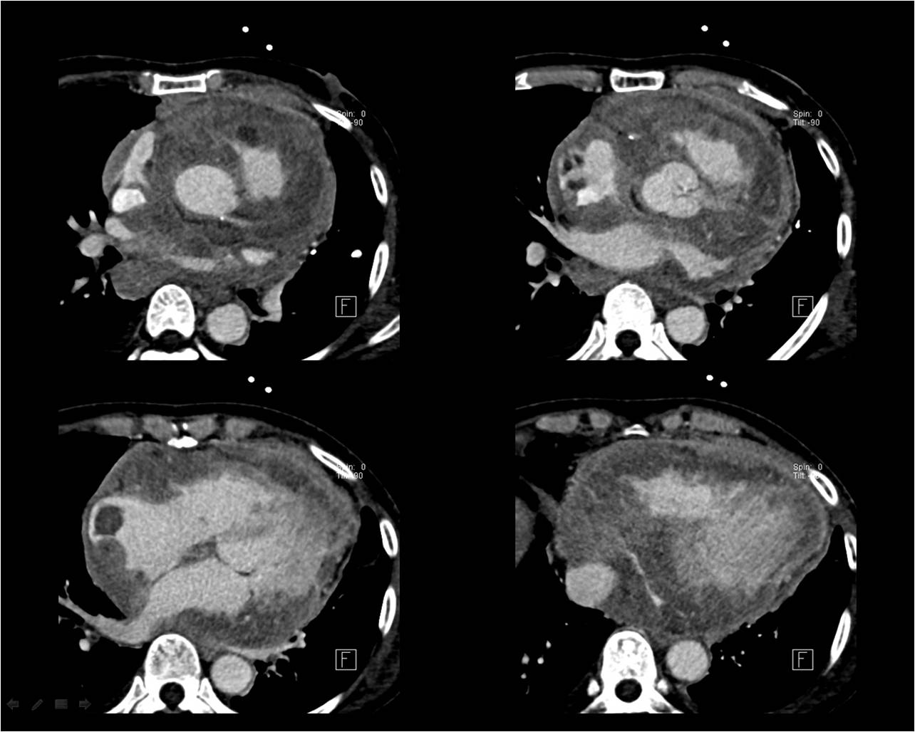 Heart   57 / F,  C.C: Dyspnea / Lab: Elevated ADA (218)