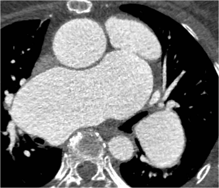 Heart F / 57 palpitation during exercise