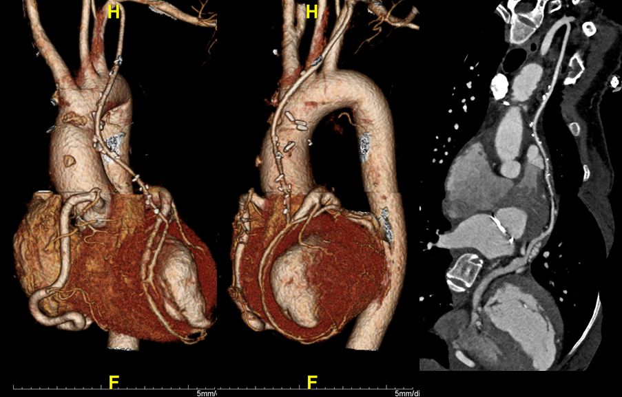 F/40, LM to PA closure with CABG (LIMA to LAD) due to ALCAPA