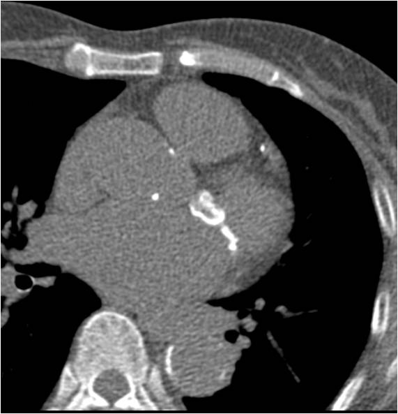 F/67, Preoperative risk factor evaluation before bladder cancer surgery