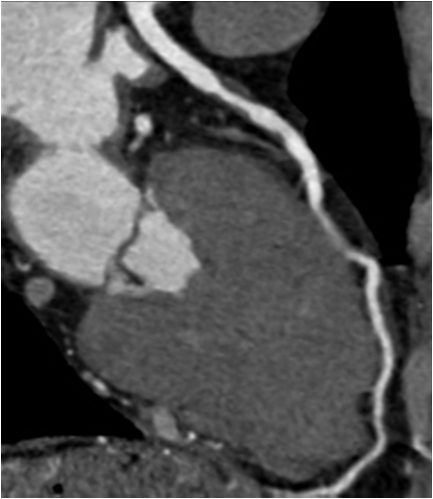 M/65<Br> C.C.: Chest Pain (since 1yr ago) / Hyperlipidemia(+) / HR at MDCT Scan: 76-85 bpm