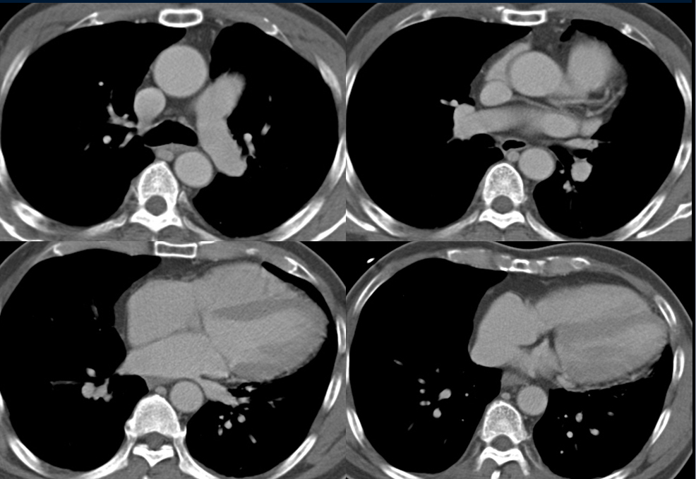 M/54<Br>C.C.: ECG Abnormality (Non-specific T Change) / CAG at Outside: Normal