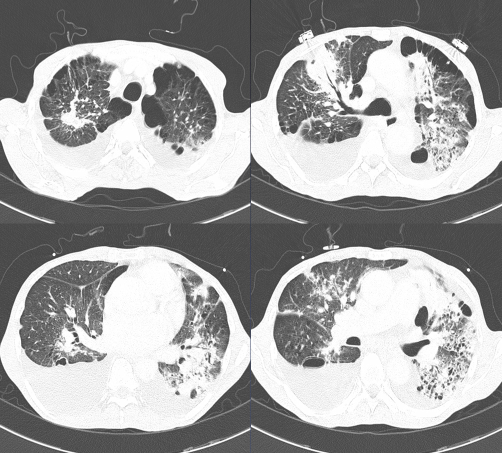 M/63<Br>C.C.: Acute Onset of Chest Pain and Aggravation of Dyspnea