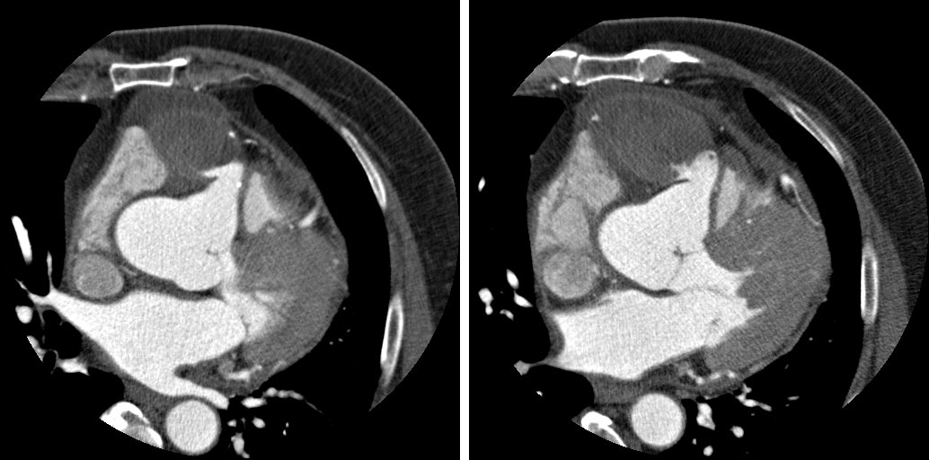 M/60<br>C.C.: Intermittent dyspnea for 3 months with recent aggravation. <br>HR at MDCT scan: 64-75 bpm