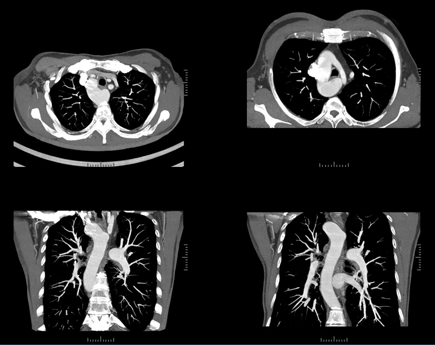 M/52 <br>C.C.: Chest discomfort, Dysphagia <BR>5YA: R/O Aortic arch aneurysm