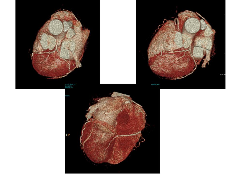 F/65 <br>C.C.:Intermittent chest pain when she was tired. No abnormal finding in 2D-echo