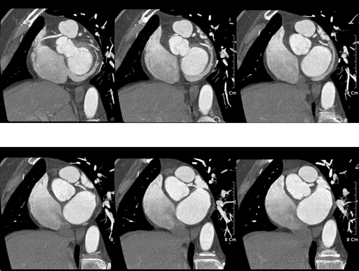 F/58<br>Chest Pain Treadmill Test(+); Chest Pain & ST Depression, Lead II Abnormal Finding on CAG