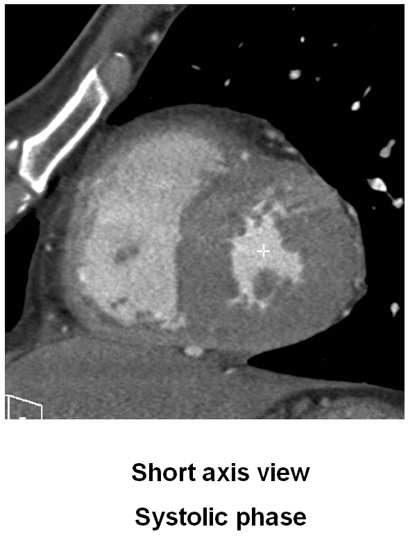 M/48<BR>C.C.: Atypical Chest Pain (since 1 month ago) / <BR>HR at MDCT scan: 66-71 bpm