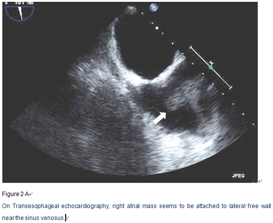 F/73, Incidentally found right atrial mass on echocardiography for evaluation of orthopedic surgery. Previous pulmonary tuberculosis (+), DM (-), HTN (-)