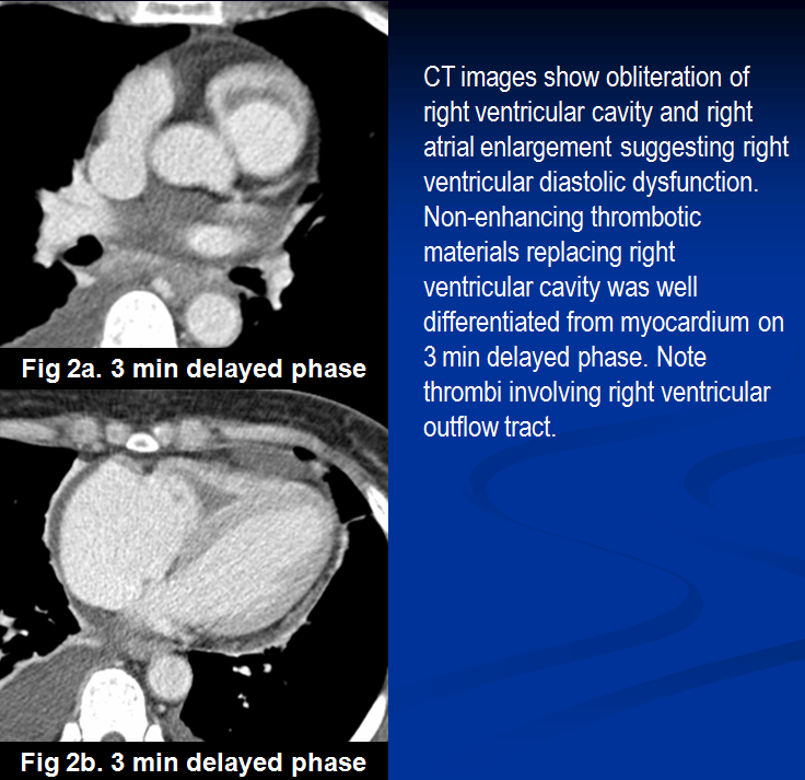 F/53, C.C dyspnea, PHx: asthma for 15 years, Lab finding: peripheral eosinophilia
