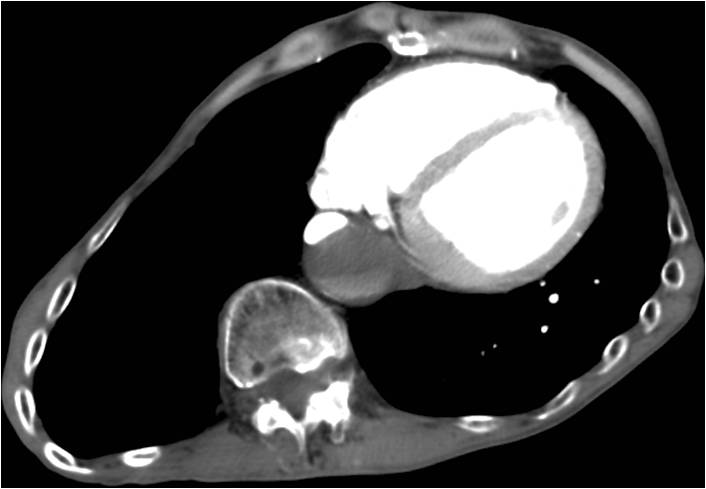 M/60, C.C.: Abrupt chest pain with radiating back pain, Past history: S/P aortic root and ascending aorta replacement (D; 10 years ago)