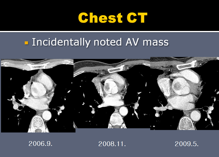 55yr / M, Lung cancer, 3 years ago