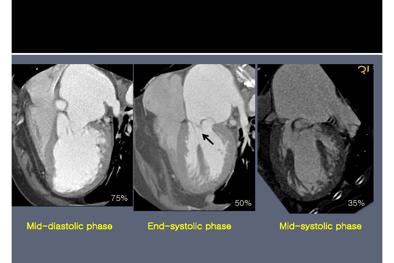 76yr / F, C.C: Dyspnea on exertion (D; 1 month)