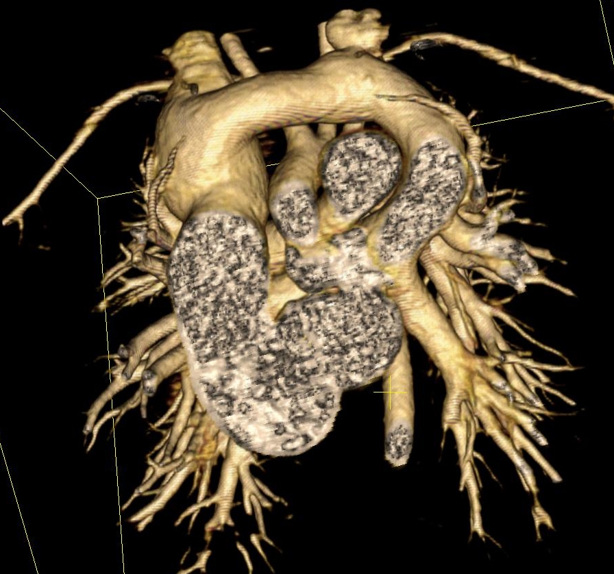 M/11 months,C.C: cardiac murmur and cyanosis found after birth