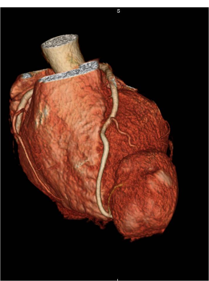 F/28, Incidental abnormality detected on chest radiography