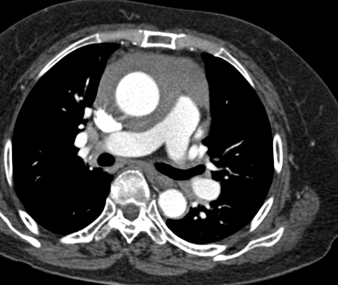 F/63, syncope w/u, PA extrinsic compression on Echo