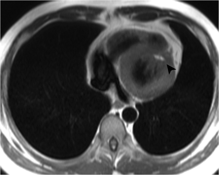 M/33, cardiac murmur