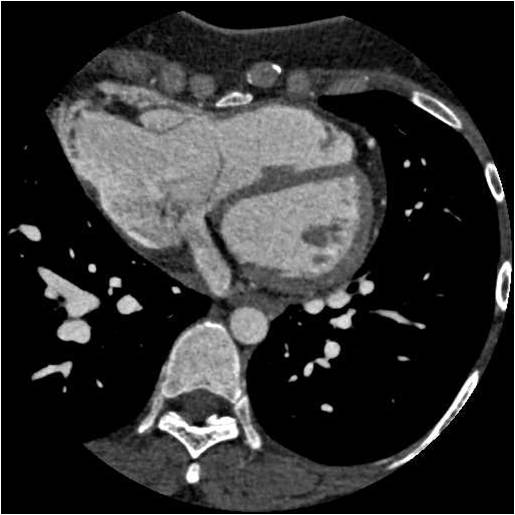 F/32, Abnormality at chest CT taken on for evaluation of cough