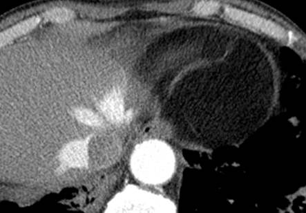 M/77, Incidental abnormality detected on chest CT