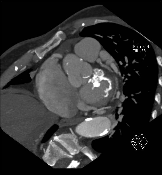 F/67, Preoperative risk factor evaluation before bladder cancer surgery