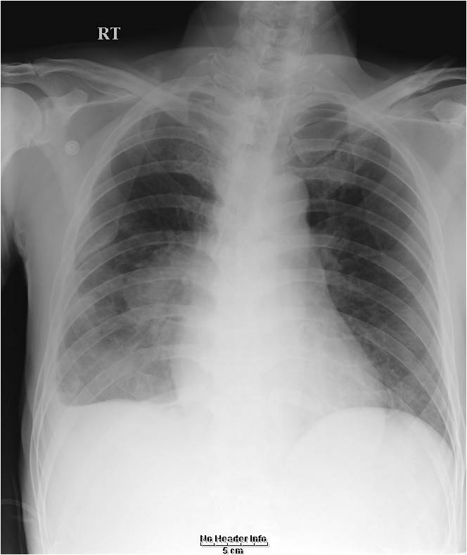 M/62, Chronic dyspnea