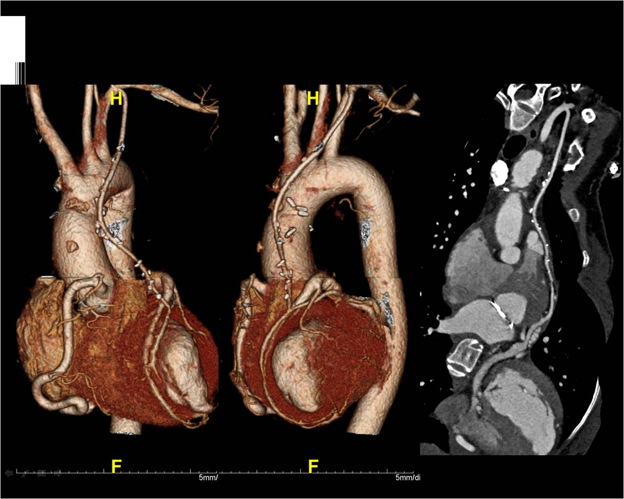 F/40, LM to PA closure with CABG (LIMA to LAD) due to ALCAPA